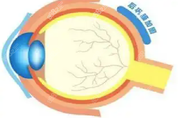 王乐今做后巩膜加固术怎样