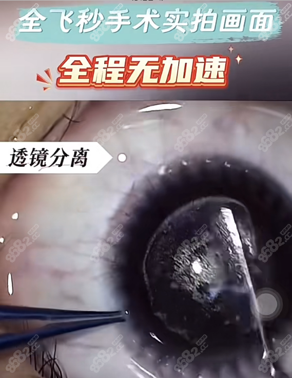 2025年中山眼科收费标准曝光