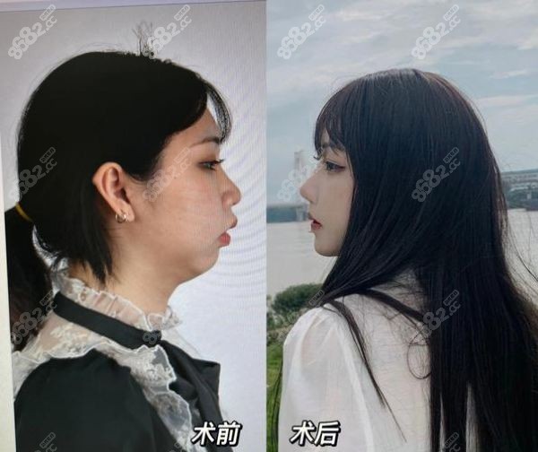 广州广大正颌手术价格