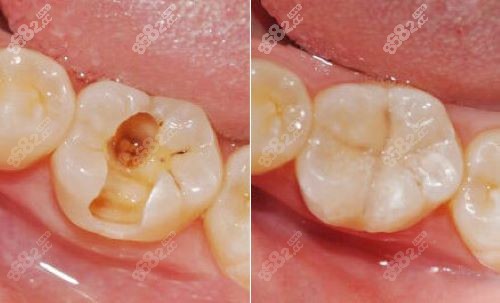 深圳华欣口腔诊所补牙价格表