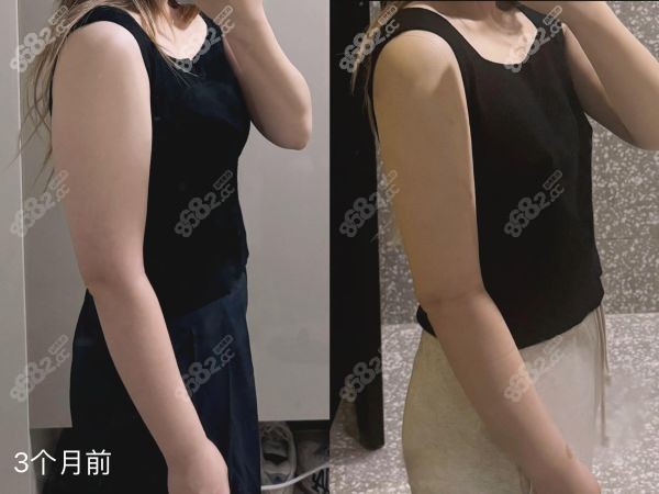 深圳阳光整形美容医院吸脂价格表