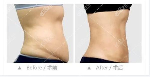 深圳阳光整形美容医院吸脂怎么样