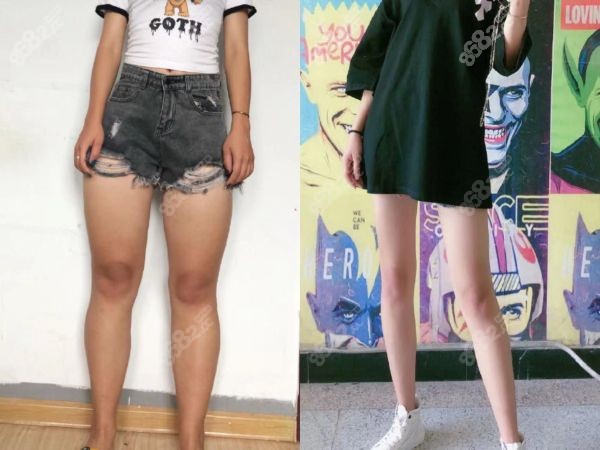 圳阳光整形美容医院吸脂口碑
