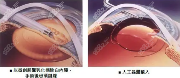 郑州白内障手术费用大概多少钱