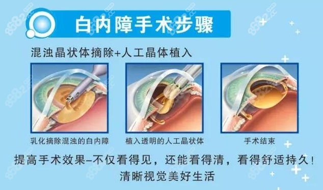 眼科张劲松医生简介：为啥大家都找他做白内障手术