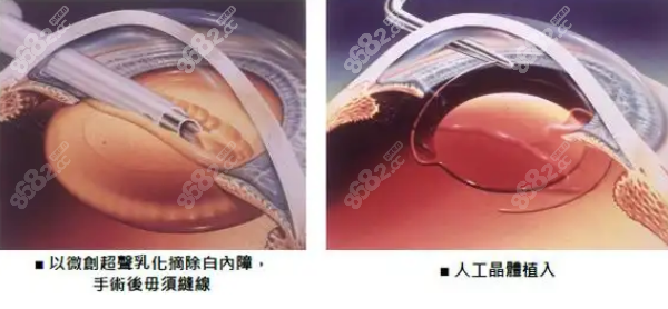 郑州二院眼科白内障手术就诊小贴士