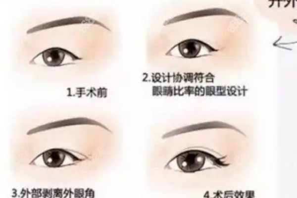 北京師麗麗雙眼皮修復(fù)費用貴嗎