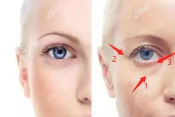 北京雙眼皮修復(fù)師麗麗怎么樣