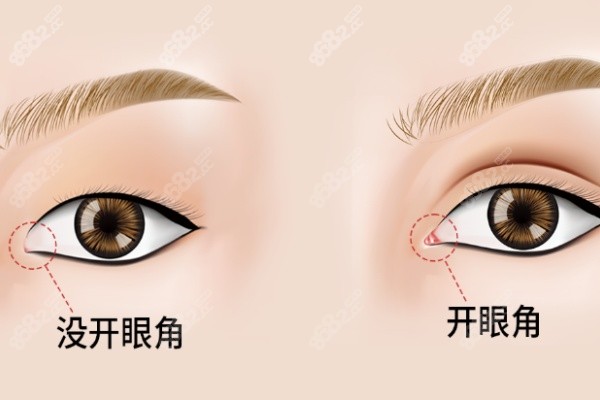 北京師麗麗雙眼皮修復(fù)