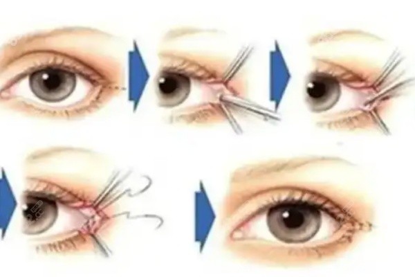 師麗麗雙眼皮修復(fù)成率大嗎