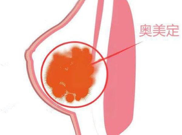 注射隆胸的哪个医院能全部取出？揭晓取出好的医院及费用