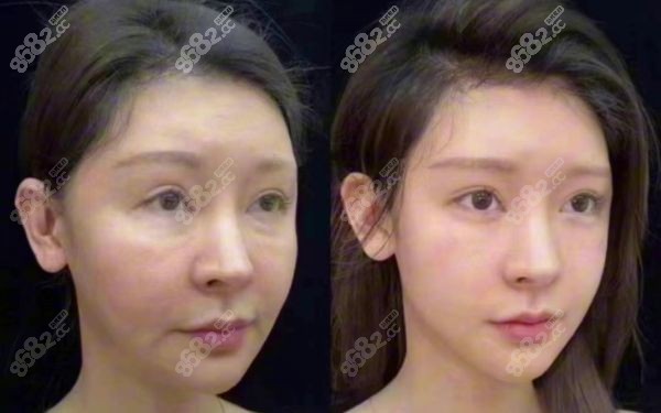 吴贞跃医生馒化脸修复怎么样
