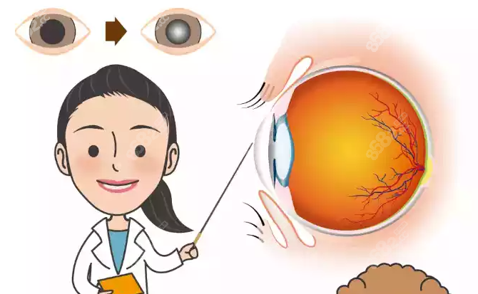 普瑞眼科医院治疗白内障非免费人群费用减免方式