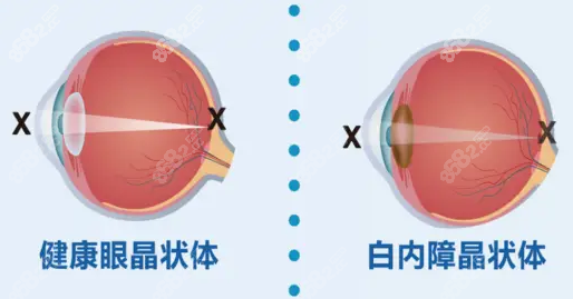 爱尔眼科白内障免费申请：官网渠道