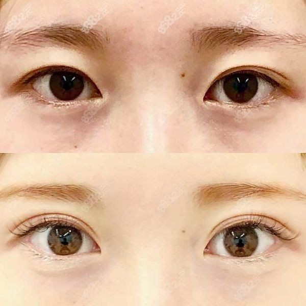 鄭州賀潔做雙眼皮怎么樣