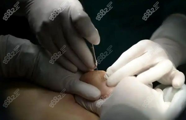 北京李方奇做异物取出怎么样
