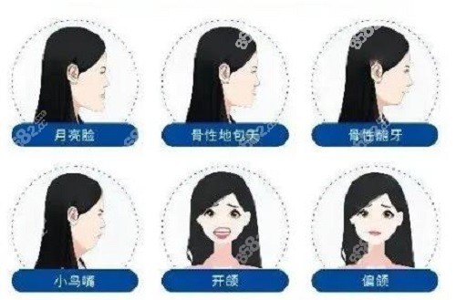 黄大勇张笑天谁下颌角做的好