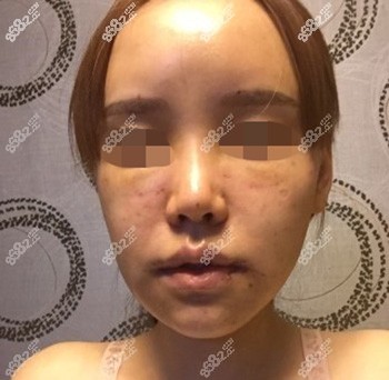 面部填充过量额头过于饱满