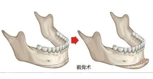 黄大勇和张笑天磨骨价格pk