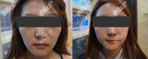 宽脸面部填充后对比