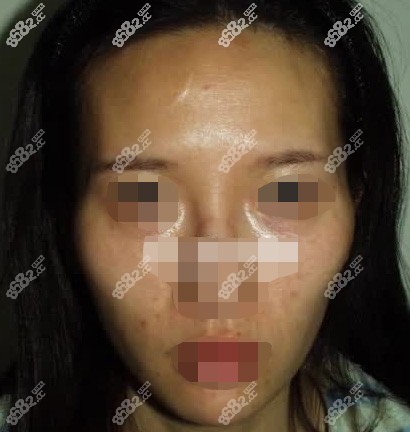 颧骨突出太阳穴凹陷的人适合面部填充