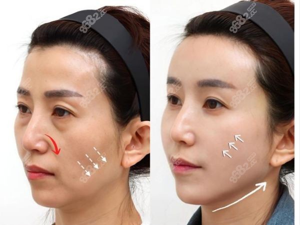 北京加减美提升面部成效好吗