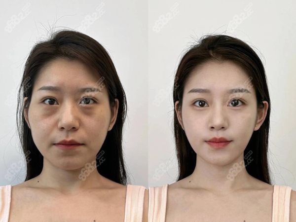 北京加减美面部提升医生