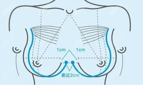 南京沈正宇隆胸怎么样？