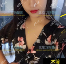 我在<!--<i data=20240705-sp></i>-->做脂肪丰胸前
