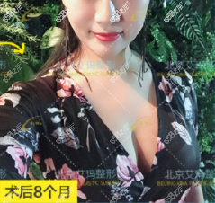 韦元强做脂肪隆胸多少钱?7万多做的浓缩脂肪丰胸案例你参考