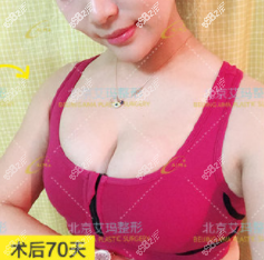 韦元强丰胸技术好吗？我找他做的SP浓缩脂肪丰胸案例参考