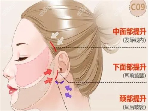 北京謝宏彬醫(yī)生的中面部內(nèi)窺鏡提升