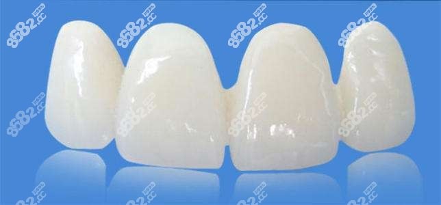 全瓷牙連冠示意圖 全瓷牙連冠示意圖