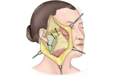 北京謝宏彬醫(yī)生的中面部內(nèi)窺鏡提升