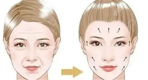北京謝宏彬醫(yī)生的中面部內(nèi)窺鏡提升