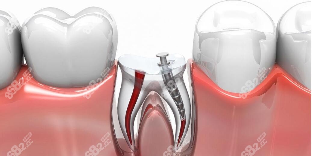 牙疼就必须根管治疗吗-www.8682.cc