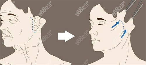 北京謝宏彬醫(yī)生的中面部內(nèi)窺鏡提升