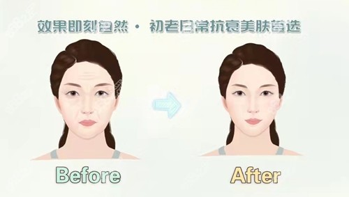 做射频紧肤前后对比