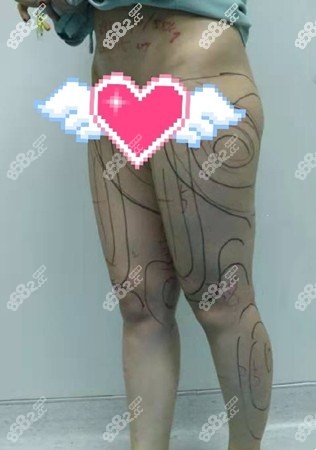 找<!--<i data=20240705-sp></i>-->吸脂前