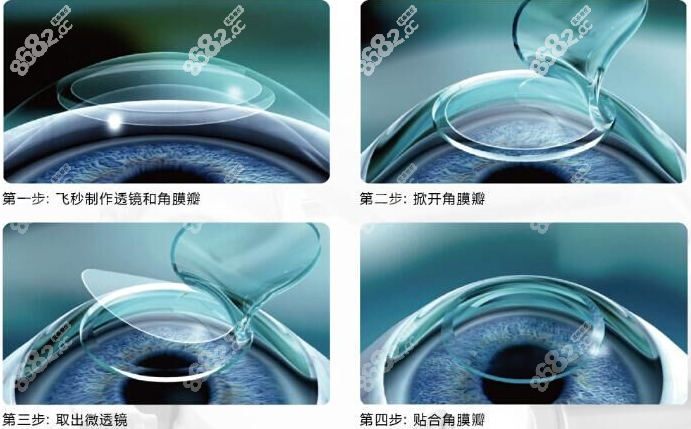 德阳近视眼手术价格表