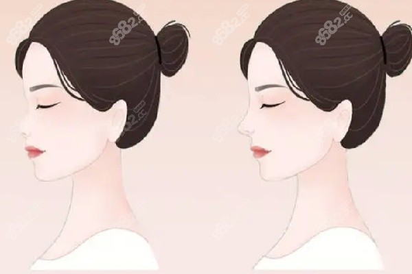 吴辉埃菲尔铁塔鼻整形价格