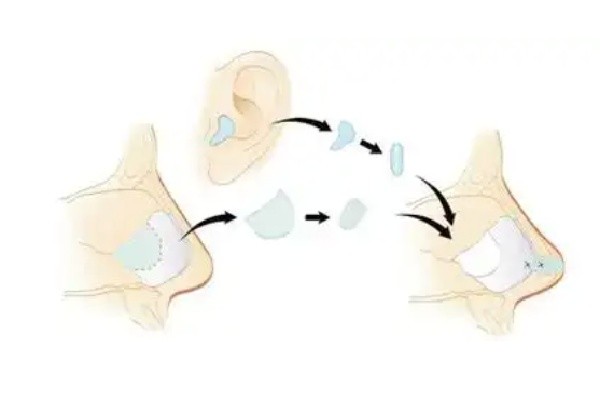 吴辉埃菲尔铁塔鼻整形预约挂号