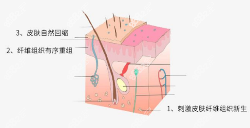 吸脂手术