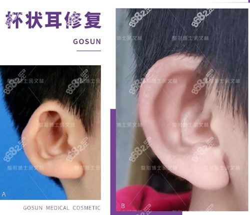 廣州高尚杯狀耳修復(fù)前后對比照