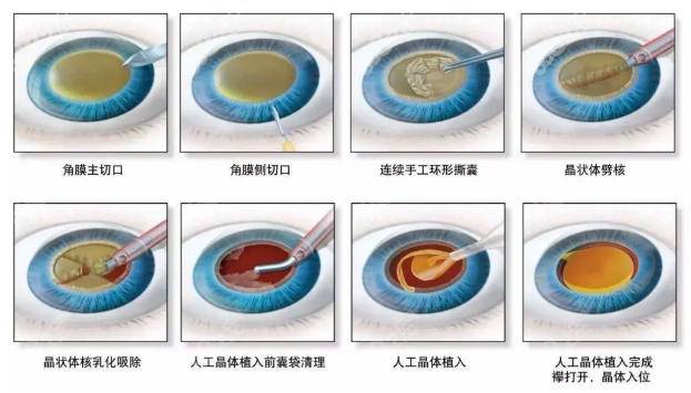 拉萨贝尔西眼科做白内障可以报销吗