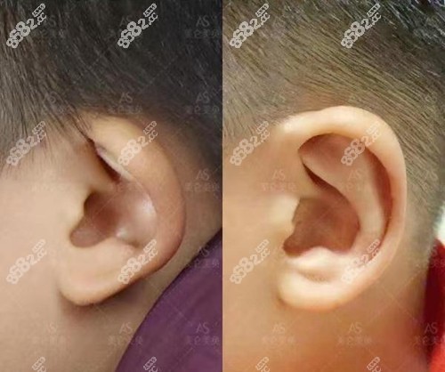 重慶美侖美奐杯狀耳修復(fù)前后對比照