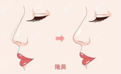 隆鼻对比图.JPG