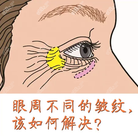 李喆眼周筋膜提升成效怎么样