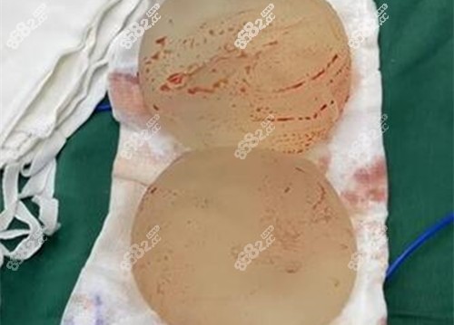 唐志荣医生隆胸修复取出的假体