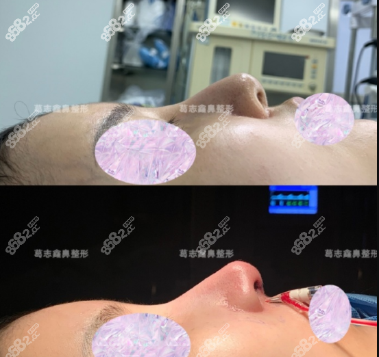 医生半肋修复实例
